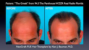 Hair Loss Treatment Center Boca Raton Fl Dr Bauman