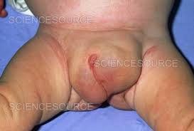 Image result for Inguinal hernia child