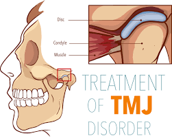 Muscle tmjd will lead to pain on both sides of the jaw joint, headaches, and a difficulty opening and closing the mouth. X4vy0ph7qhu31m