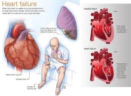 The Must Know Facts About Heart Disease In Women Ayoti Blog