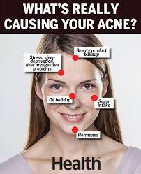 Acne Face Mapping What Acne Face Mapping Can Tell You About
