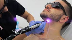 تجارب إزالة الشعر بالليزر للمنطقة الحساسة للرجال موقع زيادة