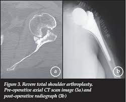 Image result for Chronic Shoulder Dislocation