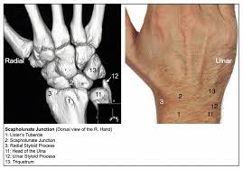 Image result for Scapholunate Dislocation