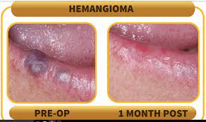 They are mainly caused by skin trauma such as forceful pinching or similar injury and typically occur on the hands and feet. Benign Hemangiomas Or Rather Why Yes We Can Remove Those Purple Blood Blister Bumps Off Of You Lip That You Hate Creekstone Dental
