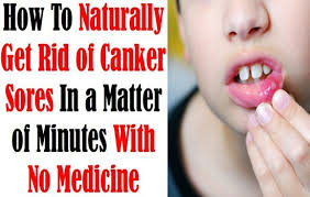 Remedies for mouth ulcers there are no quick fixes for mouth blisters as they need time to heal, but they will usually resolve on their own without treatment. Natural Easy Treatments To Get Rid Of Mouth Ulcers Fast Inminutes Magazine
