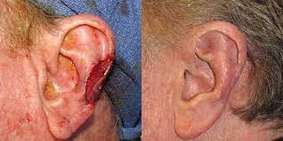 Learn more about targeted therapy, surgery, and chemotherapy. Ear Reconstruction Gallery Skin Cancer And Reconstructive Surgery Center