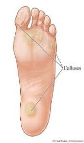 Corns And Calluses Treatment And Symptoms Advanced Foot Ankle