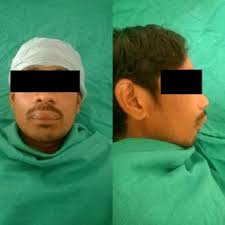 Extraoral swelling over the upper lip and oblitering the nasolabial fold.