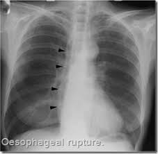 Oesophageal Rupture Air Is Seen Outlining The Right Side Of The Mediastinum Radiology Radiology Imaging Radiologic Technology