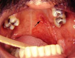 Image result for Erythroplakia roof of mouth