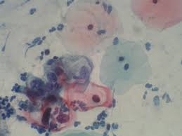 Moins de 0,5% des frottis anormaux annoncent un cancer débutant. Qu Est Ce Qu Un Frottis