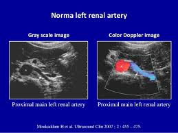 doppler ultrasound of the kidneys