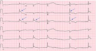 Image result for ST Elevation