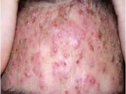 27 видео 389 925 просмотров обновлен 18 дек. Pimple Popping And Blackheads Removal 372 Youtube