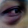 See woman with black eye and wound stock video clips. 3