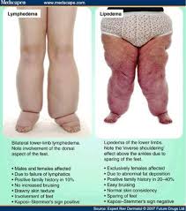 Lymphedema And Lipedema Diagram Www Anatomynote Com Nurse Nursing School Lipedema