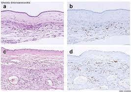 Image result for Chorioamnionitis