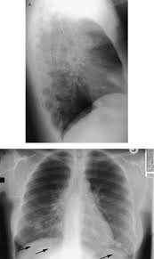 Image result for Broncholithiasis