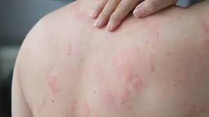 Image result for Hives