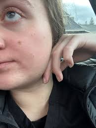 How to get rid of hyperpigmentation spots?
