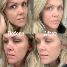 Pomifera Before And After | Scar Reduction, Skin Care, Skin