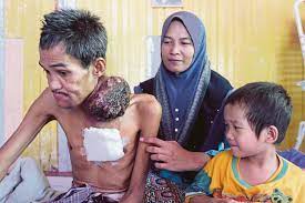 Disahkan tidak boleh menjalani rawatan kimoterapi atau radioterapi kerana tubuh beliau terlalu lemah. Tak Putus Harapan