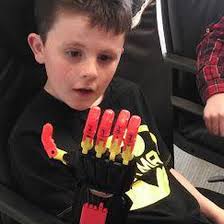 Irish schoolboy with rare birth defect amazed by his new 3D printed hand