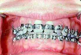 Several bond fans remember dolly having braces, to coordinate with jaws' metal teeth. Ok Maybe There Is Something To The Mandela Effect Page 7 Ar15 Com
