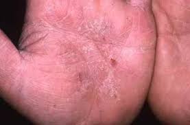 See full list on doctissimo.fr Mycose Et Dishidrose Eczema Mains Eczema Champignon Peau