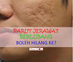 Luka parut akibat jerawat dibedakan menjadi empat jenis, dan mengetahui jenis luka parut yang anda alami dapat membantu anda menentukan perawatan yang tepat1 x teliti sumber Cara Hilangkan Parut Berlubang Dengan Berkesan Tanpa Perlu Laser Sweet Moms Vitamin Cantik Dan Sihat Dengan Vitamin Semulajadi Shaklee