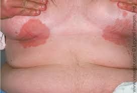 Intertrigo is most frequently seen in overweight people, diabetics intertrigo is most commonly seen in skin fold areas. Intertrigo And Secondary Skin Infections American Family Physician