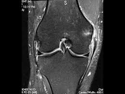 The medial collateral ligament is one of four ligaments that help stabilize the knee.; Grade 3 Medial Collateral Ligament Mcl Tear Youtube