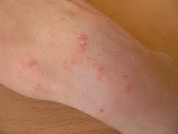 Image result for scabies human bites