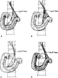 A band of smooth muscle extending from the junction of the duodenum and jejunum to the left crus of the diaphragm and functioning as a suspensory ligament. Figure 1 From Treitz Redux The Ligament Of Treitz Revisited Semantic Scholar