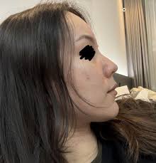 Rhinoplasty at Eight Plastic Surgery