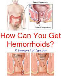 Can Hemorrhoids Be Cured With Creams Is Epsom Salt Bad For Hemorrhoids Do Hemorrhoids Need To Bleed Hemorrhoid Remedies Hemorrhoids Treatment Hemorrhoids
