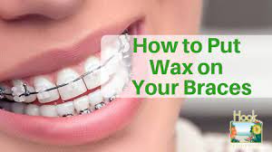 Before you try to apply them, make sure that the brace is dry. How To Put Wax On Your Braces