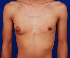 We'd like to share some information about the disease, and we hope we can reassure you while we pass along some facts and resources. Unilateral Gynecomastia What You Need To Know About One Sided Gyno