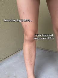 Image result for liver spots on legs