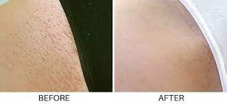Search reviews of 0 leesburg businesses by price, type, or location. Laser Hair Removal Permanent Hair Reduction In Northern Virgina