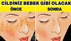 Bu Yontemle Cildiniz Piril Piril Olacak Akne Tedavisi Sivilce Izi Dogal Akne Tedavisi