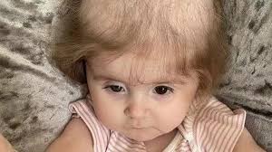 Girl with condition that makes her pull hair out is to get head shaved to  raise funds for child with cancer