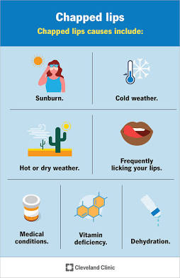 Common causes of chapped lips, AI generated