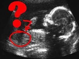 Is Your Baby A Boy Or A Girl Pregnancy Health Guru Youtube