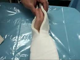 Image result for Radial Gutter Cast