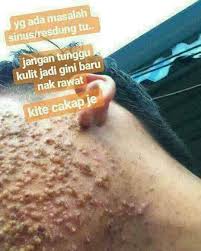 Ulat berkenaan kebiasaannya akan dikeluarkan dengan proses rawatan membakar kon berasap ke muka. Facebook