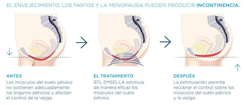 La vejiga en la menopausia