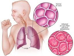 Dengan meminum air sebanyak 8 gelas seuai saran dari dokter, maka tubuh akan menjadi lebih sehat dan tentunya dengan mengkonsumsi makanan yang sehat dan bergizi. Terapi Refleksi Untuk Mengobati Paru Paru Basah