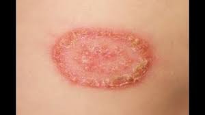 Diagnosis akan diberikan mengikut kawasan yang dijangkiti. Cara Merawat Kurap Penyembuhan Penyakit 2021